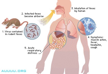 Acute respiratory distress syndrome, HUMAN RESPIRATORY DISEASES AND DISORDERS