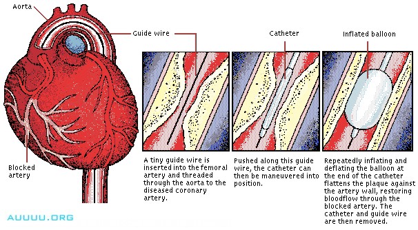 CORONARY HEART DISEASE: Balloon Angioplasty