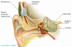 HEARING: How a Cochlear Implant Works